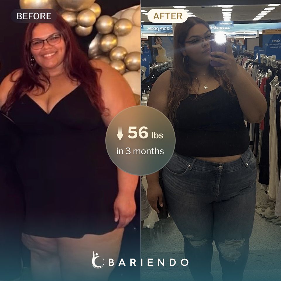 Ciaralyn lost 56 pounds in 3 months with an ESG from Bariendo