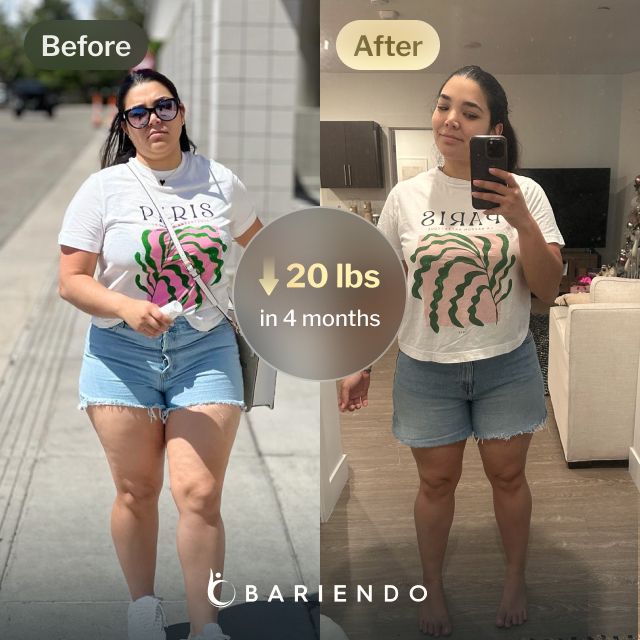 Before and after image of Ruxibeth who lost 20 pounds in 4 months with a gastric balloon procedure