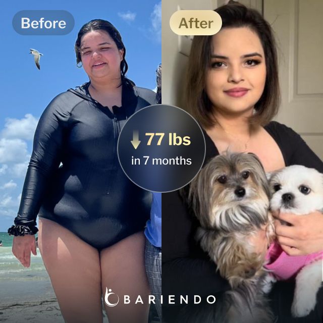 Before and after images of Nicole, a Bariendo ESG Stomach Tightening® patient who lose 77 pounds in 7 months