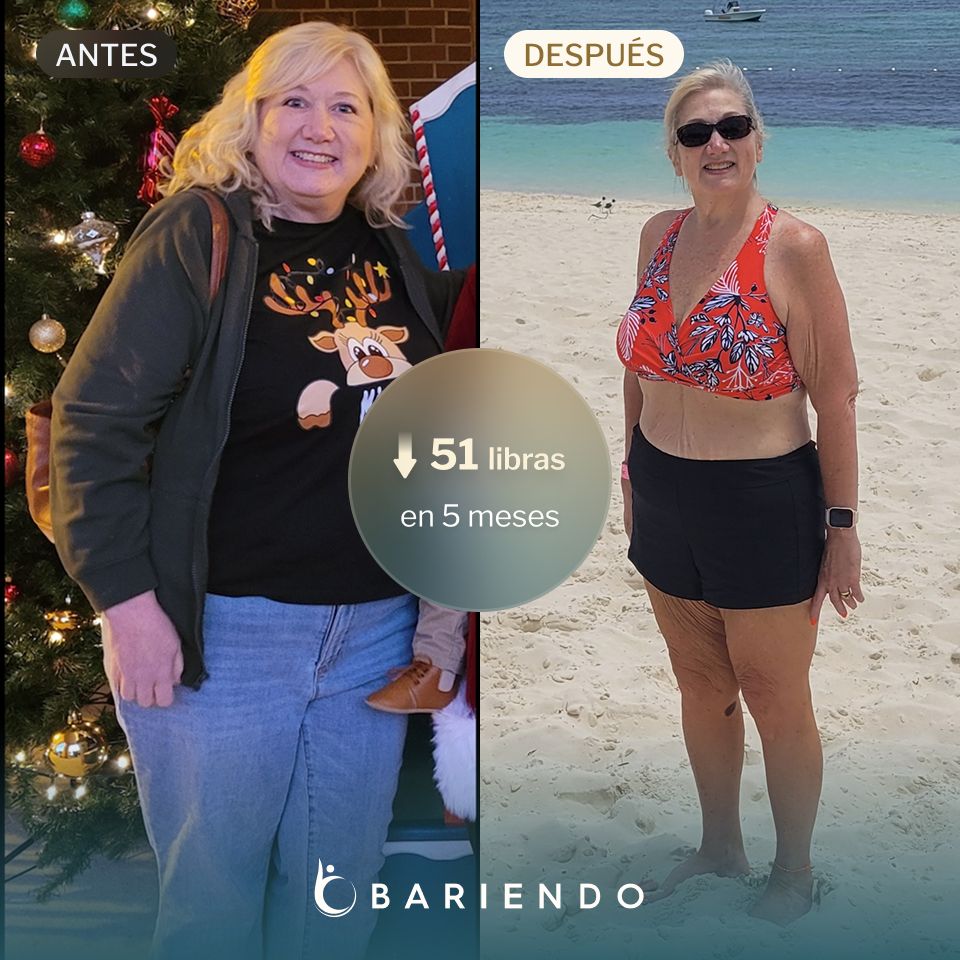 Caroline lost 51 pounds with an ESG from Bariendo