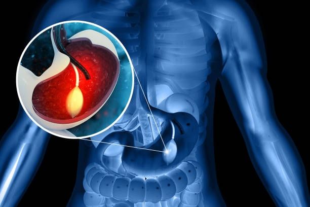 Ilustración 3D de un balón gástrico dentro de un estómago