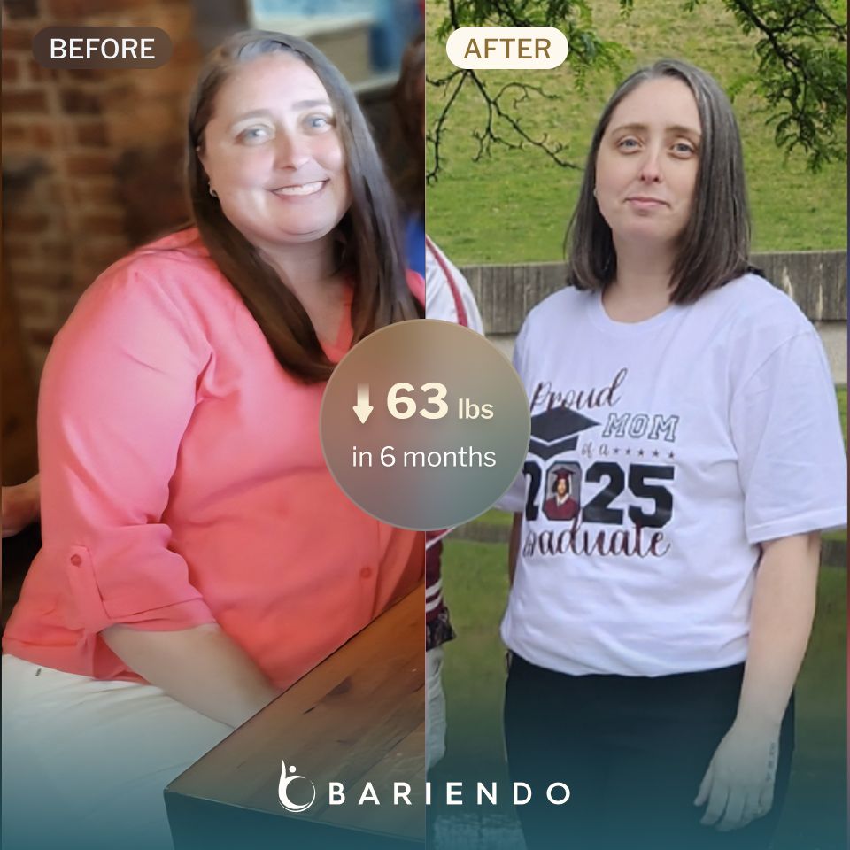 Helen got a fresh start and lost 63 pounds with Bariendo's ESG procedure
