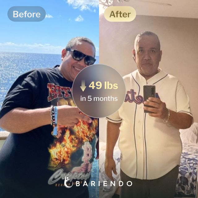 Before and after images of Cesar who lost 49 pounds in 5 months through Bariendo's ESG Stomach Tightening® procedure