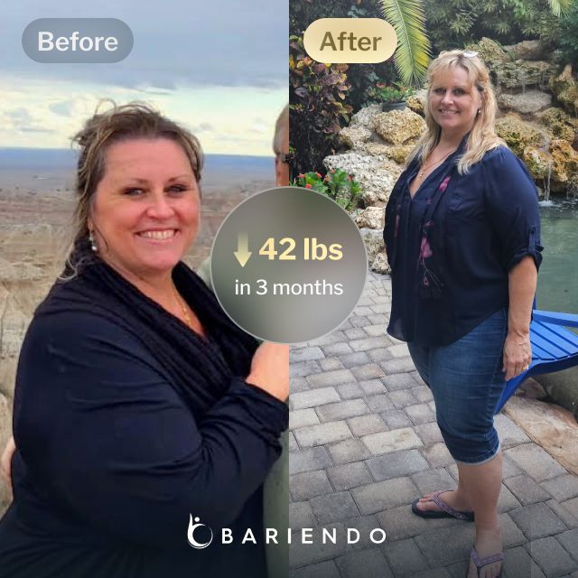 Before and after images of Lisa who lost 42 pounds in 3 months after an ESG procedure