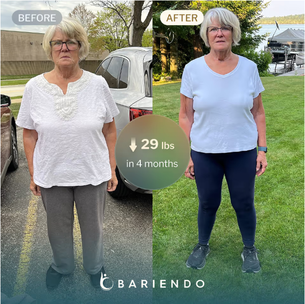 Foto del antes y después de una mujer rubia mayor que muestra el progreso de pérdida de peso con ESG Stomach Tightening