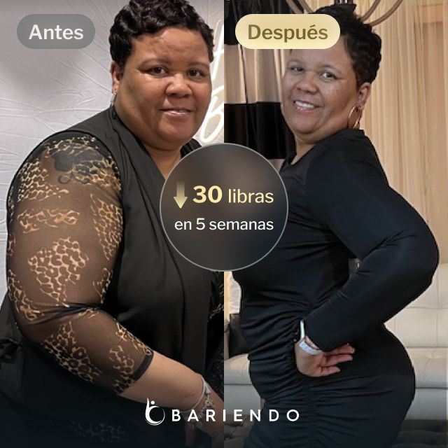 Imágenes de antes y después de Gwendolyn que perdió 30 libras en 5 semanas después de un procedimiento ESG