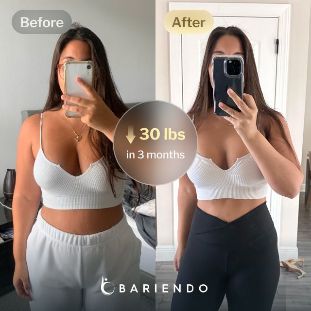 Before and after images of Patricia, a Bariendo ESG Stomach Tightening® patient who lost 30 pounds in 3 months