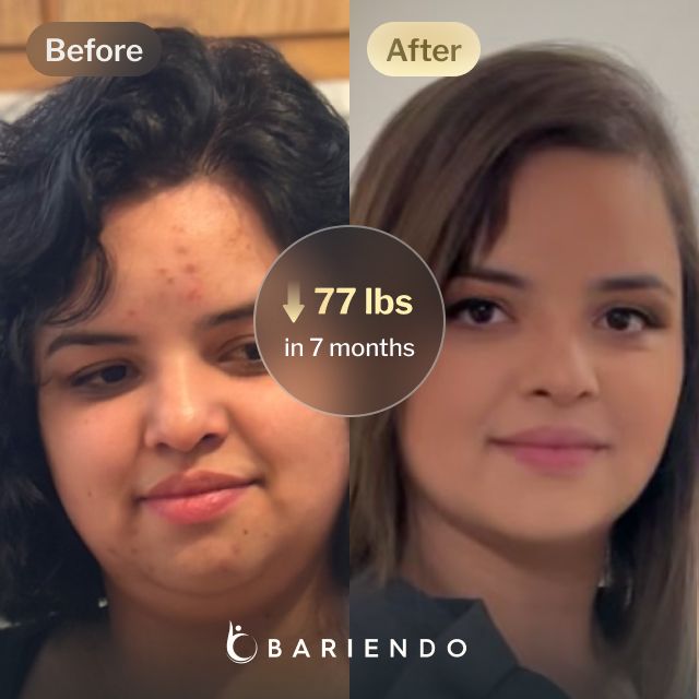 Before and after images of Nicole, a Bariendo ESG Stomach Tightening® patient who lose 77 pounds in 7 months