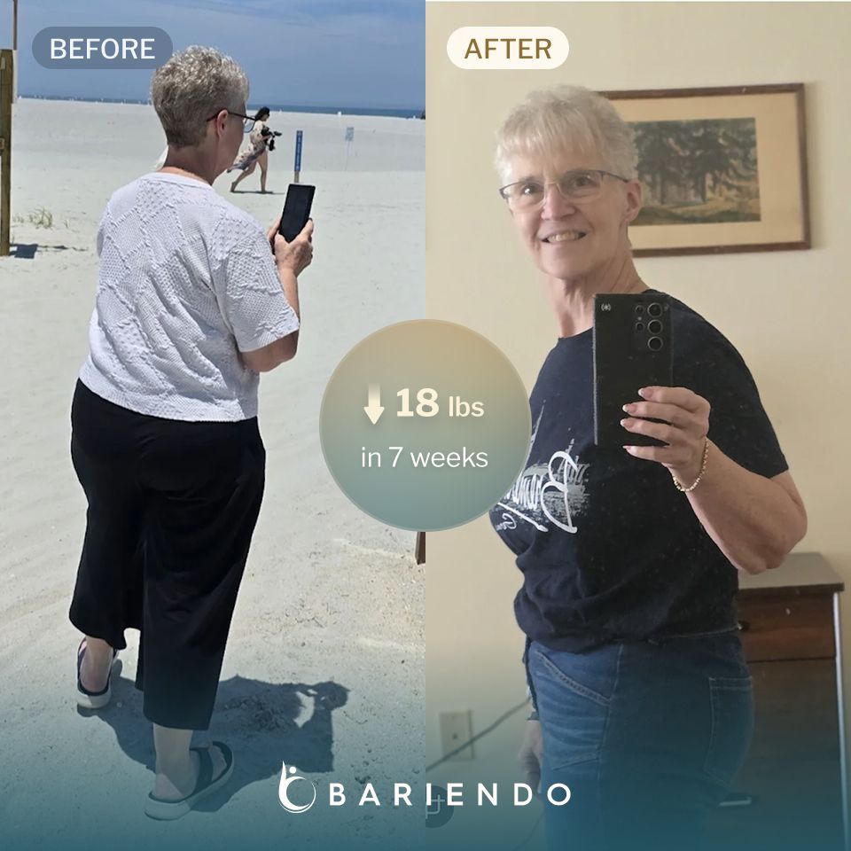 Diane lost 18 lbs with a TORe revision procedure with Bariendo