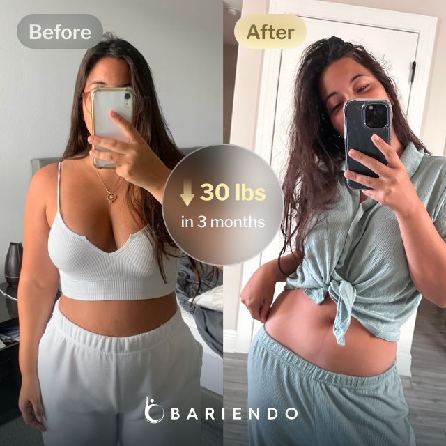 Before and after images of Patricia, a Bariendo ESG Stomach Tightening® patient who lost 30 pounds in 3 months