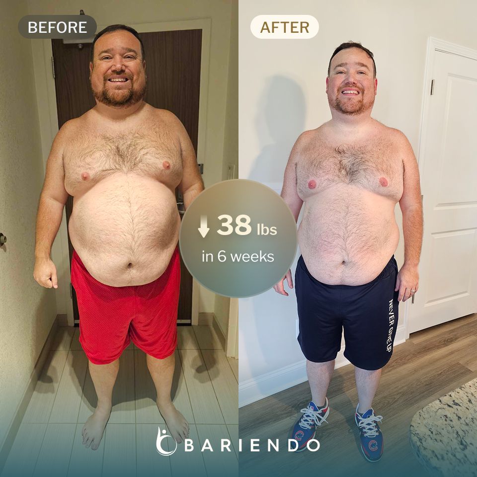 Clint has lost 38 lbs with Bariendo's revision of sleeve gastrectomy procedure