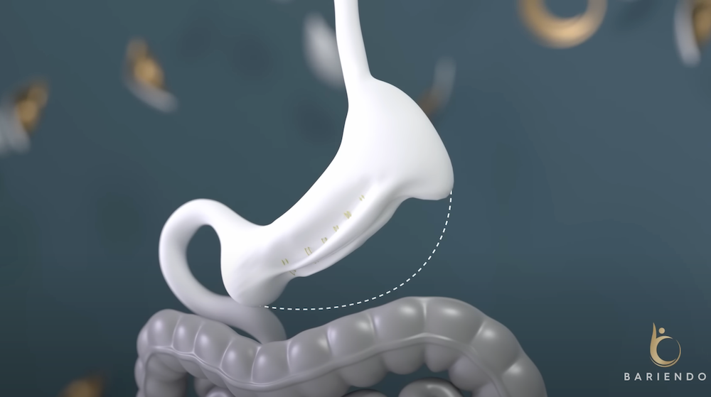 Diagrama ESG (endoscopic sleeve gastroplasty)